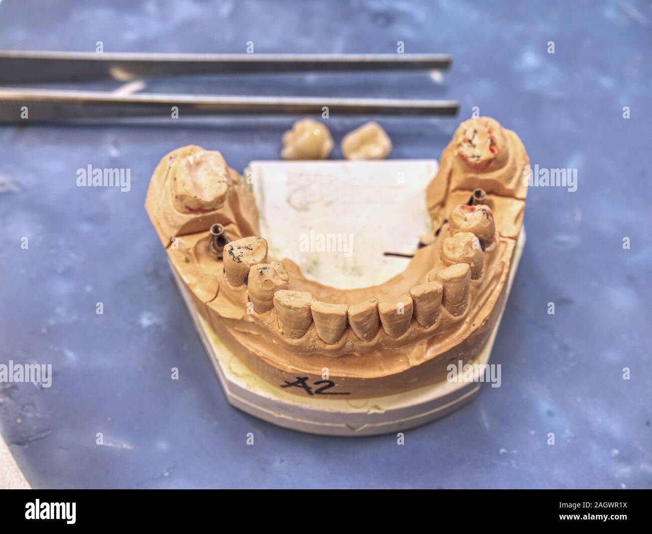 Dental prosthesis in semiprocess. Test of artificial tooth prosthetic, handmade modern dental ceramics implantat. The denture, false teeth. Stock Photo