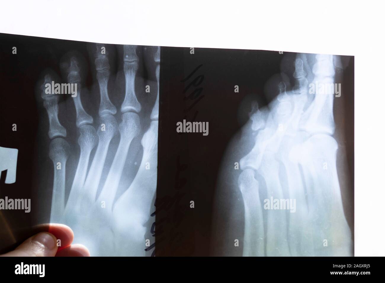 Broken leg. Xray image show closed fracture left leg Stock Photo Alamy