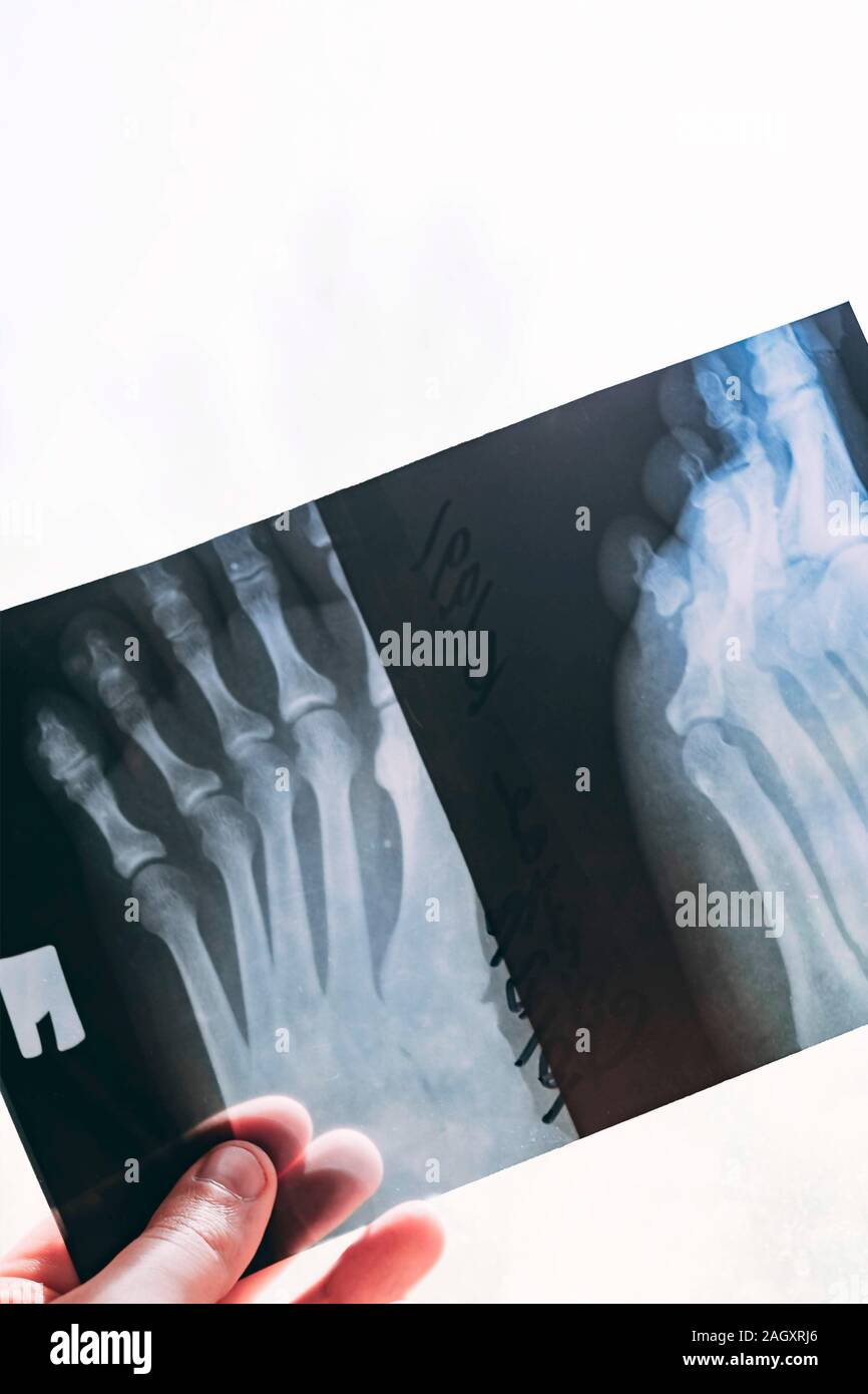 Broken leg. Xrays of leg fracture patients Stock Photo Alamy