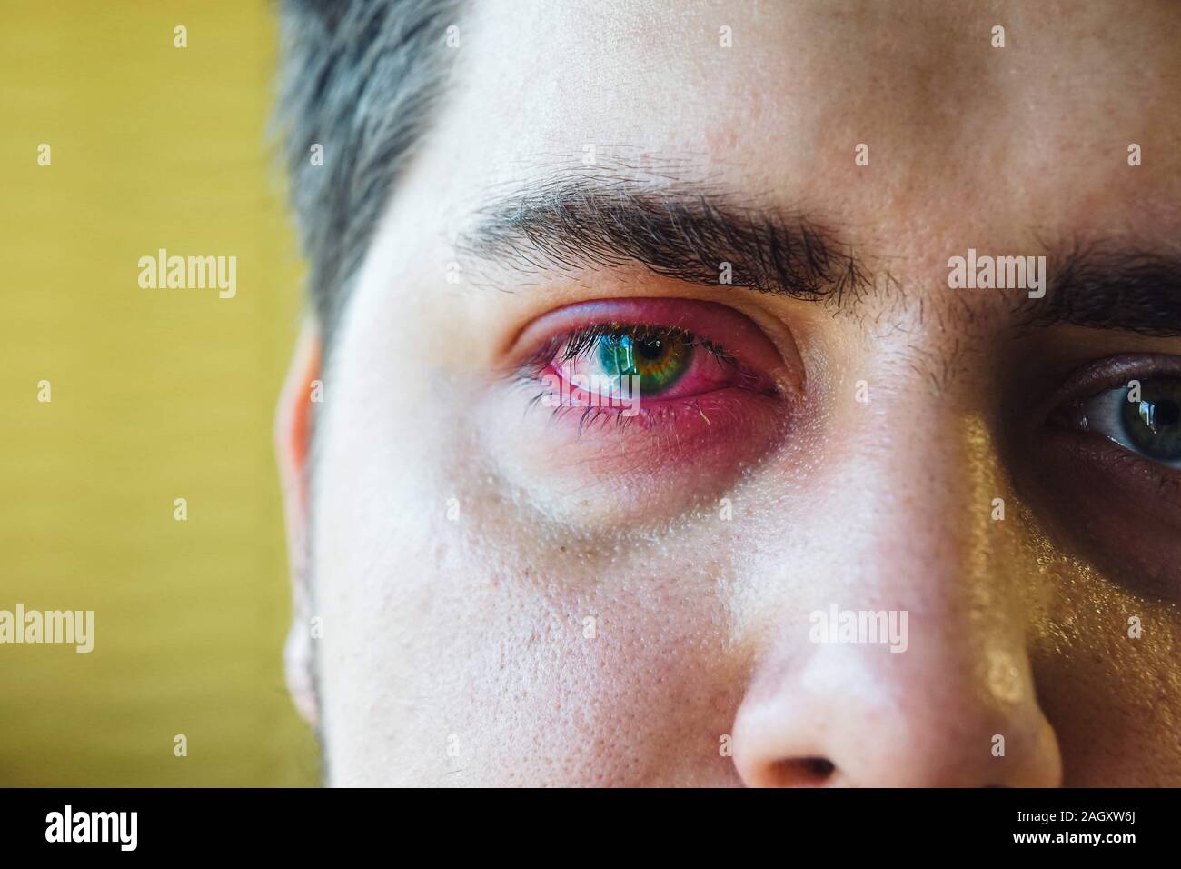 Close up right upper eyelid abscess Stock Photo Alamy