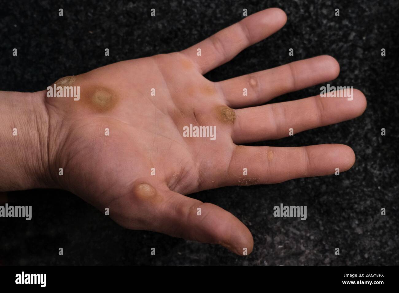 Dermatological issue,verruca warts,on worker man hand,medical healthcare concept Stock Photo