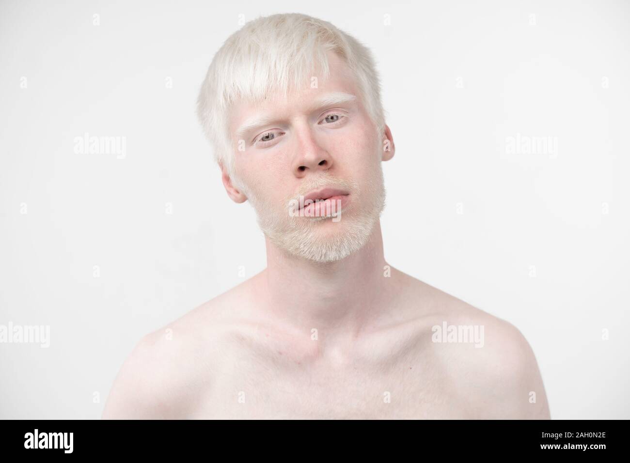 portrait of an albino man in studio dressed t-shirt isolated on a white  background. abnormal deviations. unusual appearance. skin abnormality Stock  Photo - Alamy