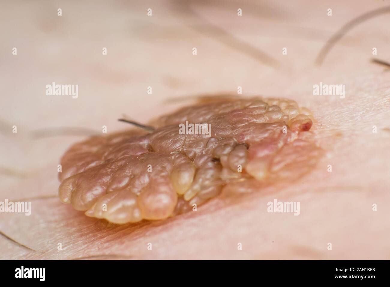 Macro photo of a skin wart, papilloma virus infection Stock Photo