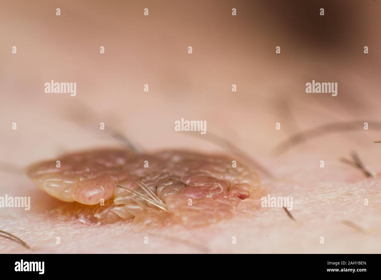 Macro photo of a skin wart, papilloma virus infection Stock Photo