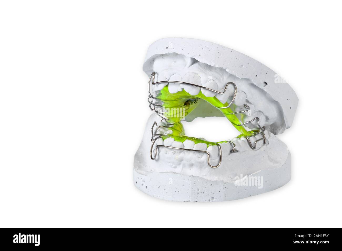 Retainer Casting Retainer with plaster cast Stock Photo - Alamy