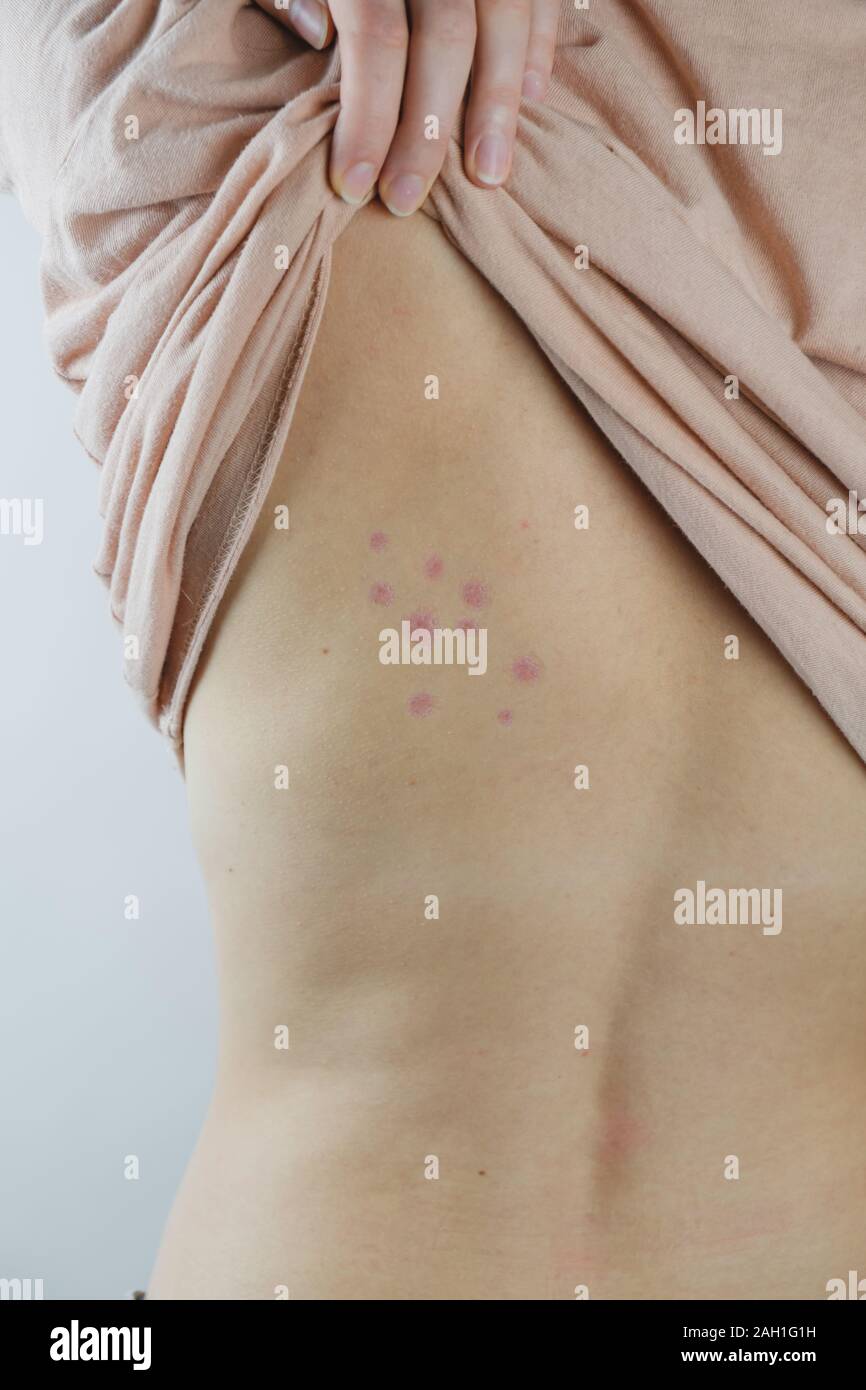 Damaged skin on female's back. Bedbug bites, moosquito bites or skin disease on human body, vertical shot Stock Photo