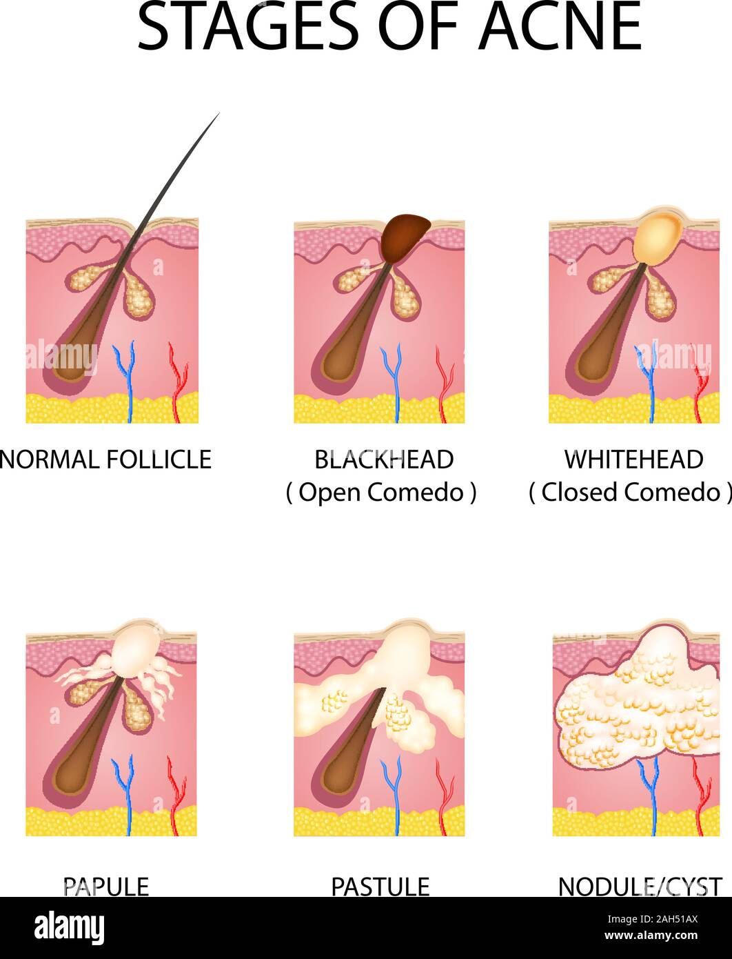 Stages of acne formation in the human skin Stock Vector Image & Art Alamy