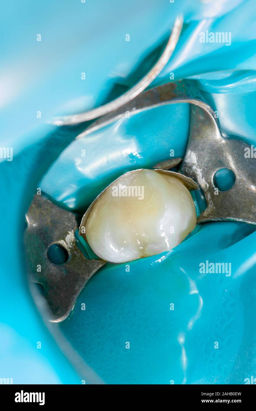 Dental caries. Filling with dental composite photopolymer material