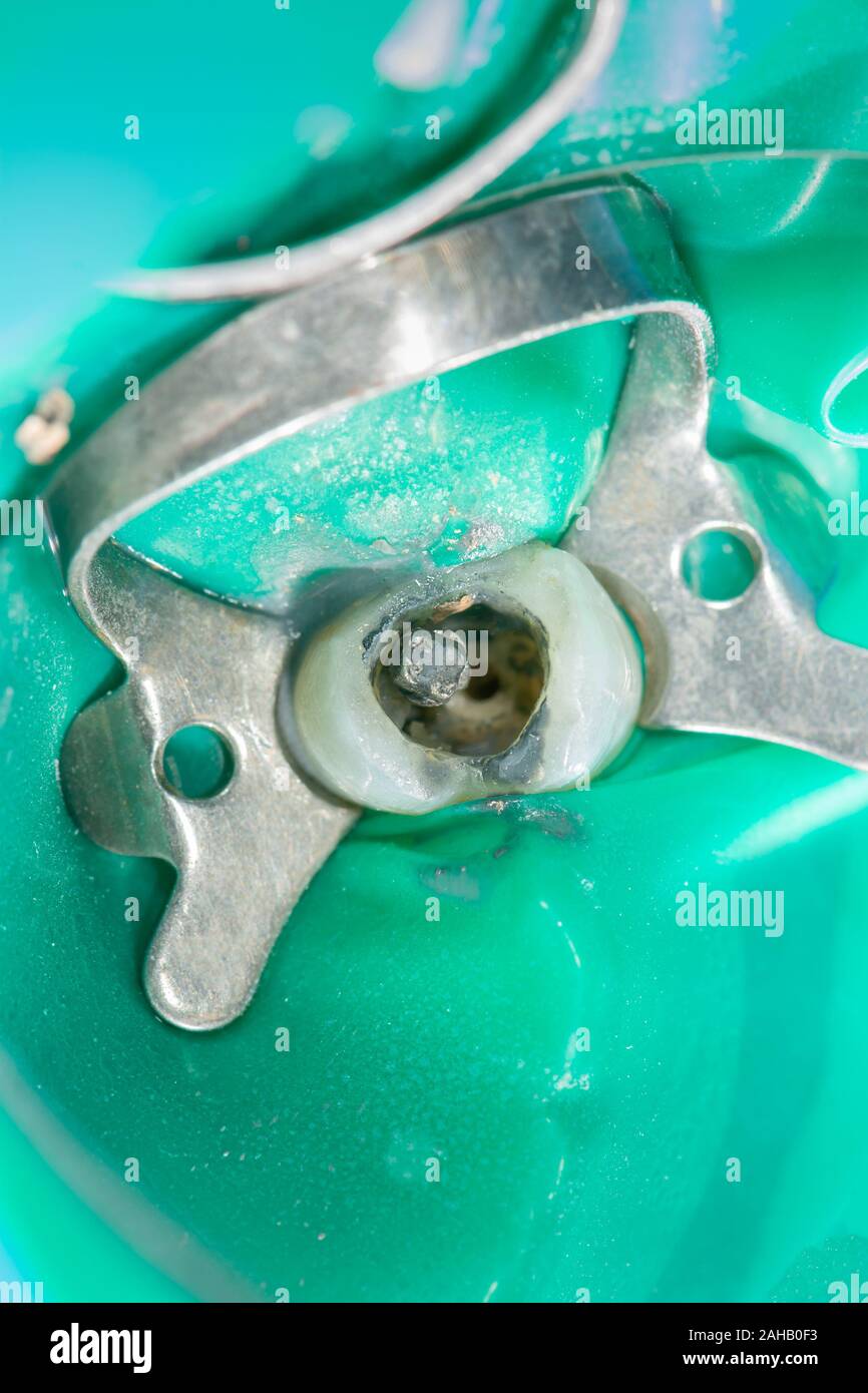 endodontic treatment of teeth closeup. Cleaning of the roots of the teeth and their filling