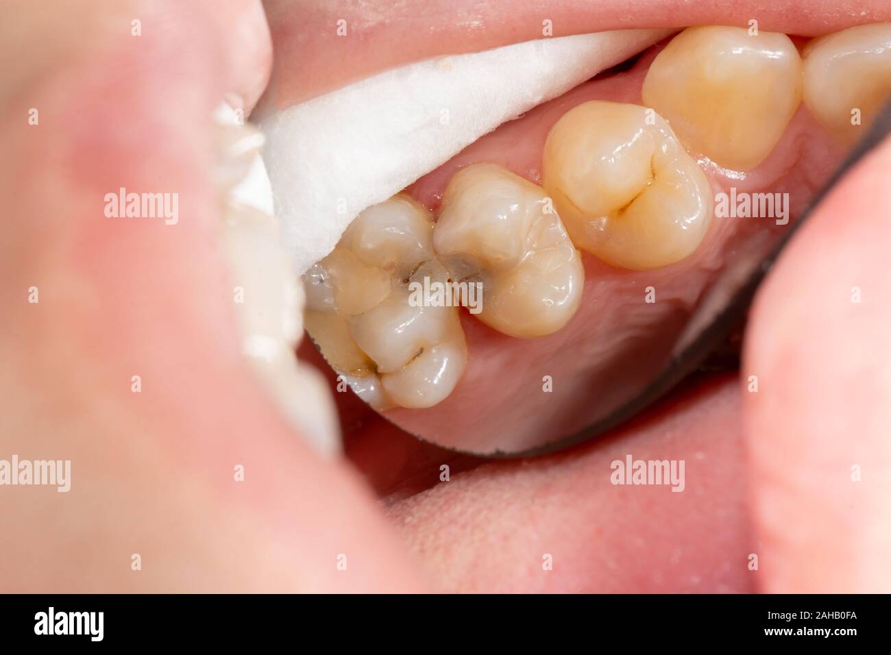 Dental caries. Filling with dental composite photopolymer material
