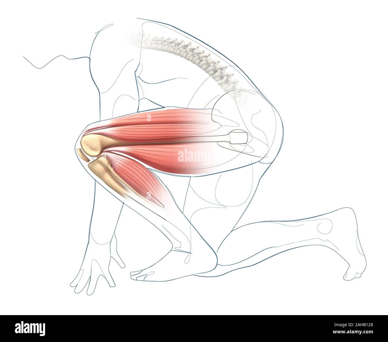 Bursitis of the hip joint - Stock Image - C011/0413 - Science Photo Library