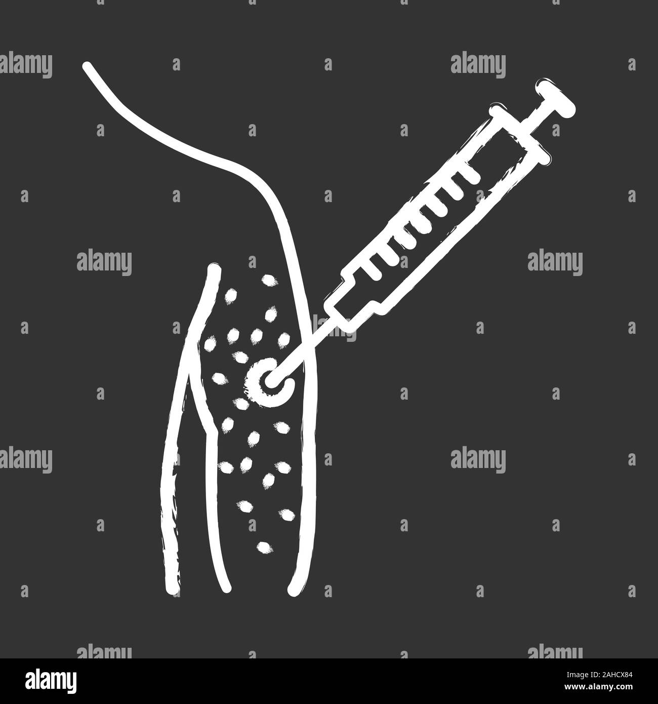 Vaccine allergy chalk icon. Vaccination injection. Syringe in arm. Drug injecting. Skin rash, irritation. Isolated vector chalkboard illustration Stock Vector