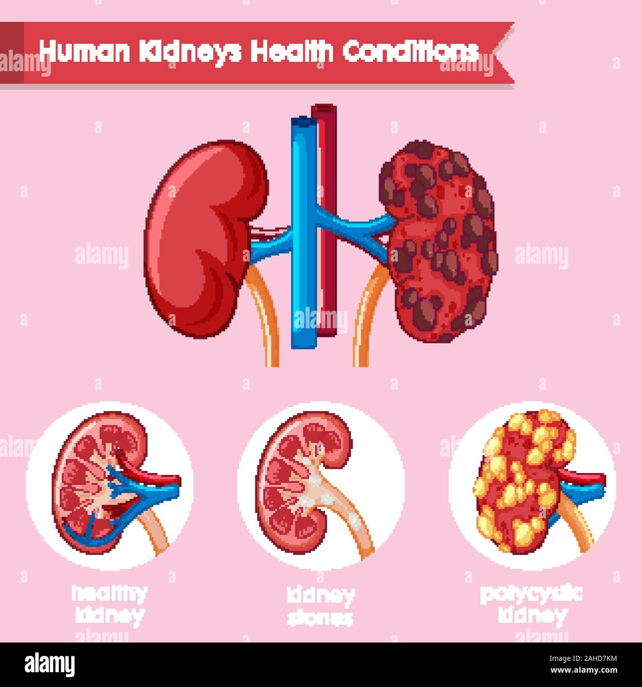 Polycystic kidney disease hi-res stock photography and images - Alamy