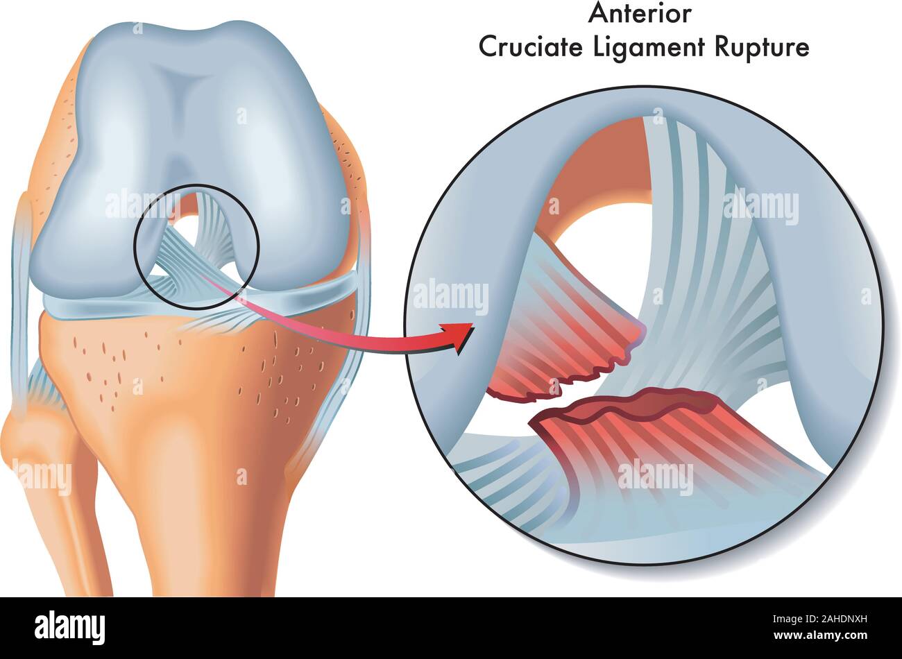 Medical Illustration of anterior cruciate ligament rupture. Stock Vector