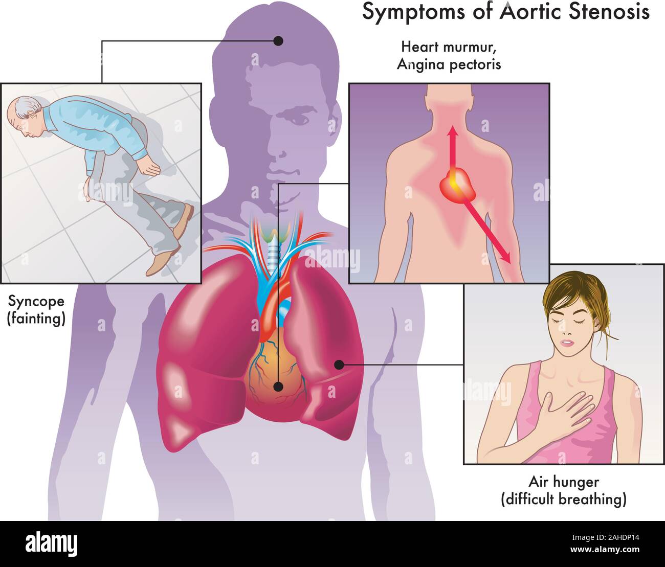 Medical illustration of the symptoms of aortic stenosis. Stock Vector