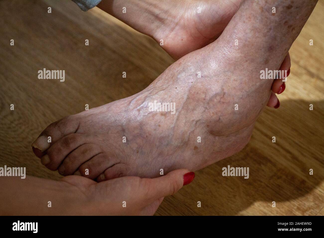 Lepromatous hires stock photography and images Alamy