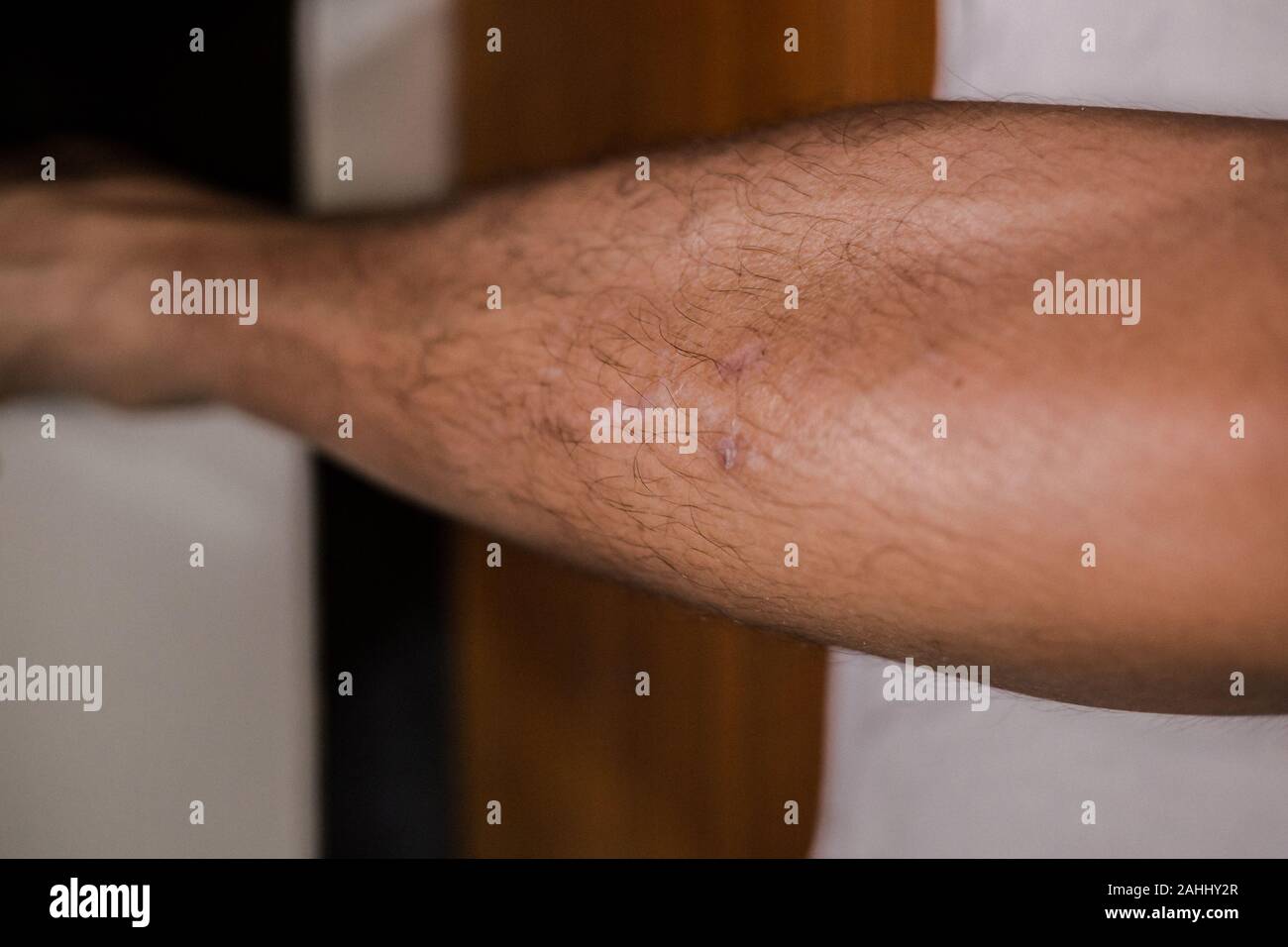many scar from scratching accident of strong leg Stock Photo Alamy