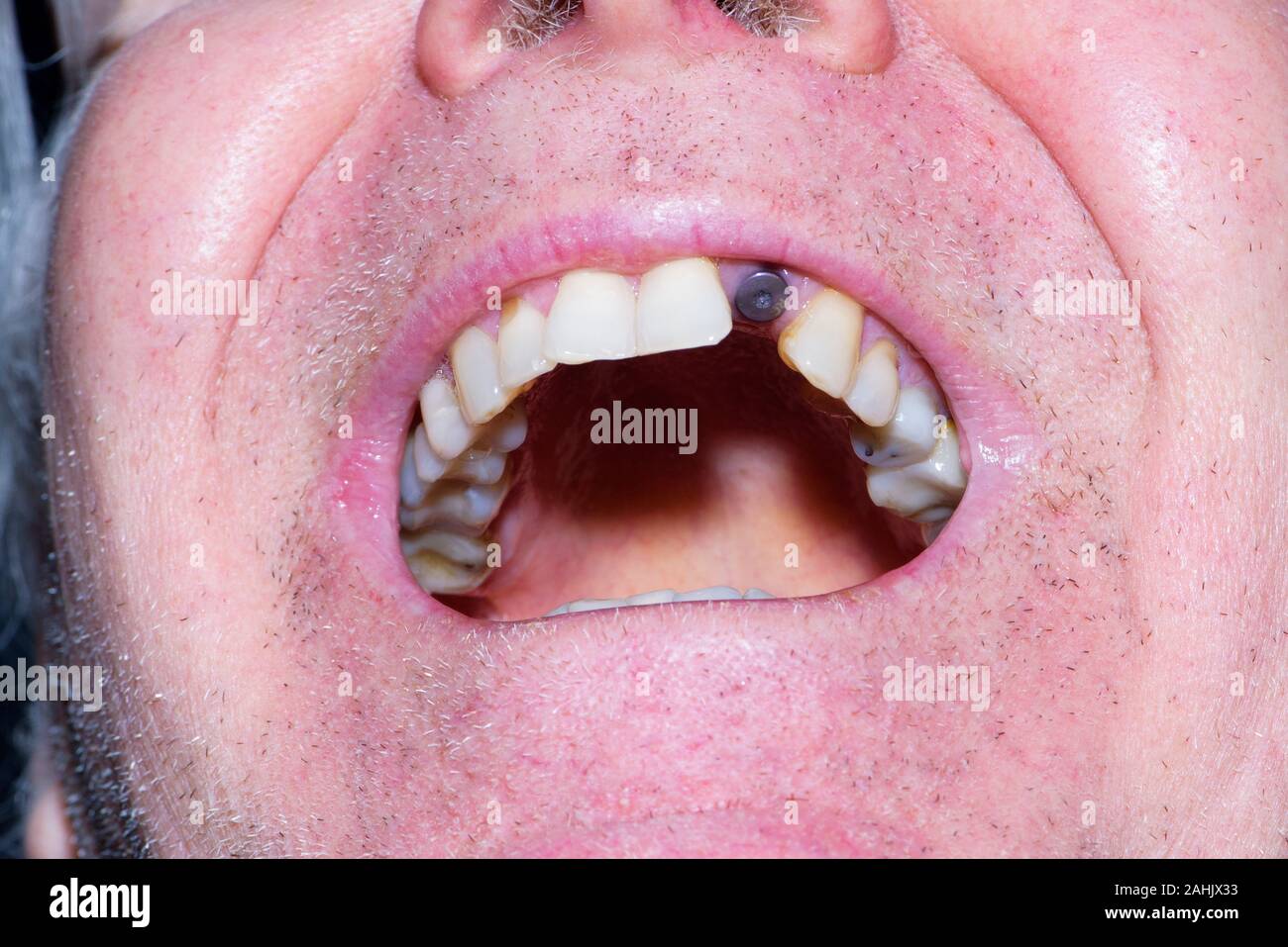 Healing cap screwed into dental implant, awaiting for the installation