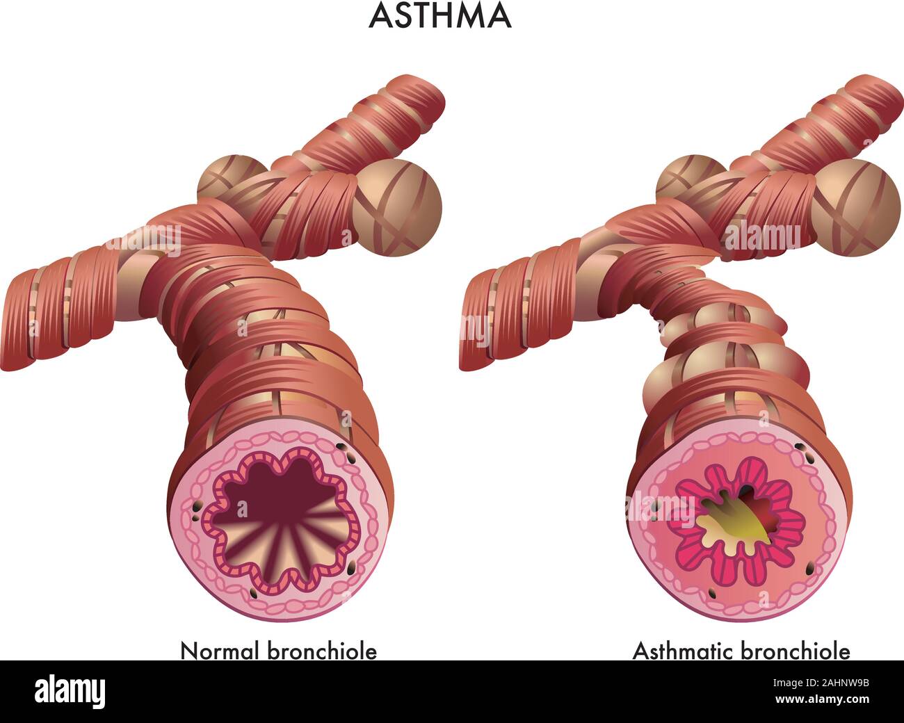 Medical illustration of the effects of the Asthma. Stock Vector