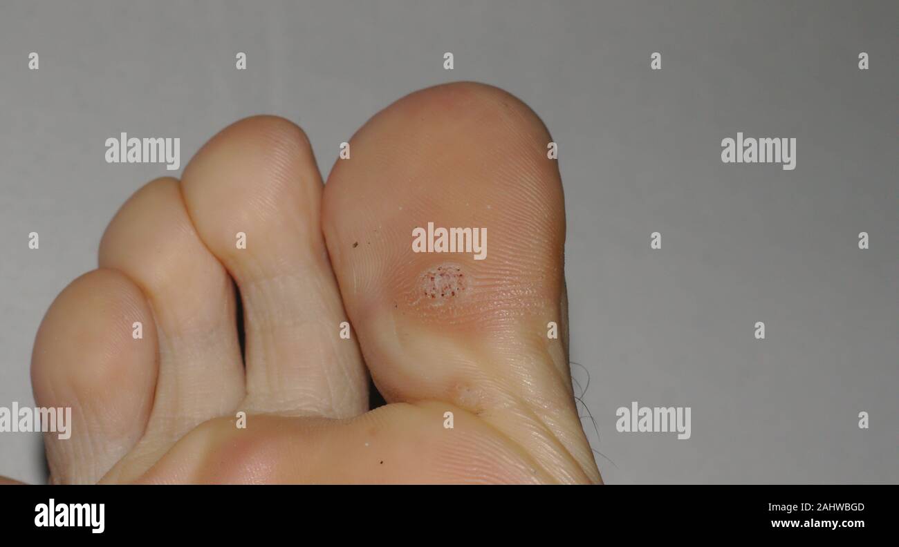 Plantar wart hires stock photography and images Alamy