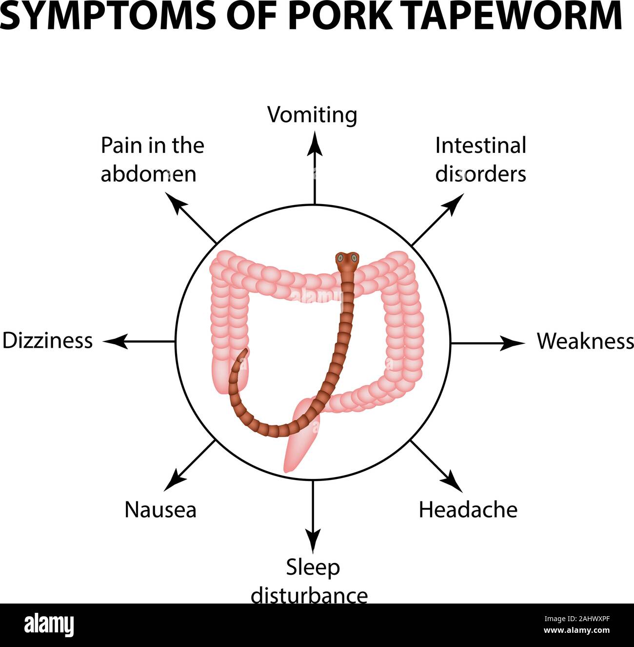 Symptoms of Pork tapeworm. Infographics. Vector illustration on isolated background Stock Vector