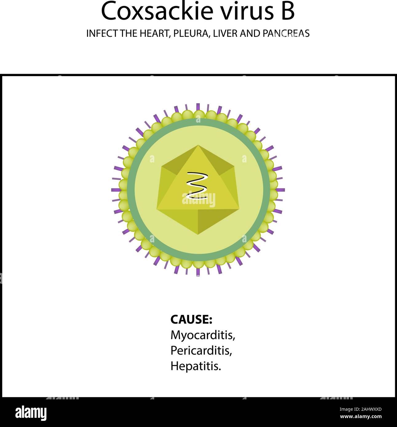 The structure of Coxsackie Virus B. Symptoms of the disease. Enterovirus. Infographics. Vector illustration on isolated background Stock Vector