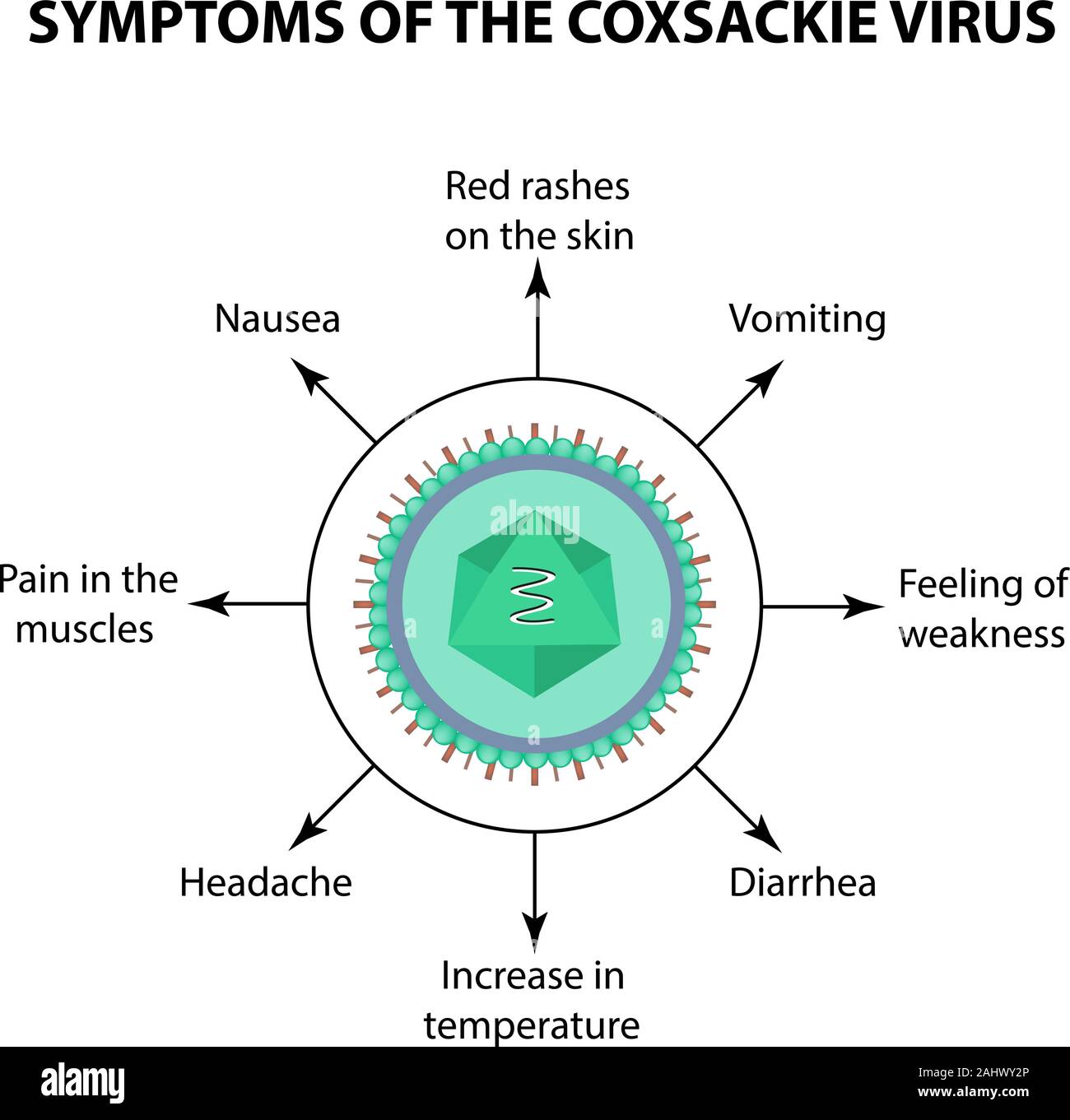 Symptoms of infection Coxsackie virus. Enterovirus. Infographics. Vector illustration on isolated background Stock Vector