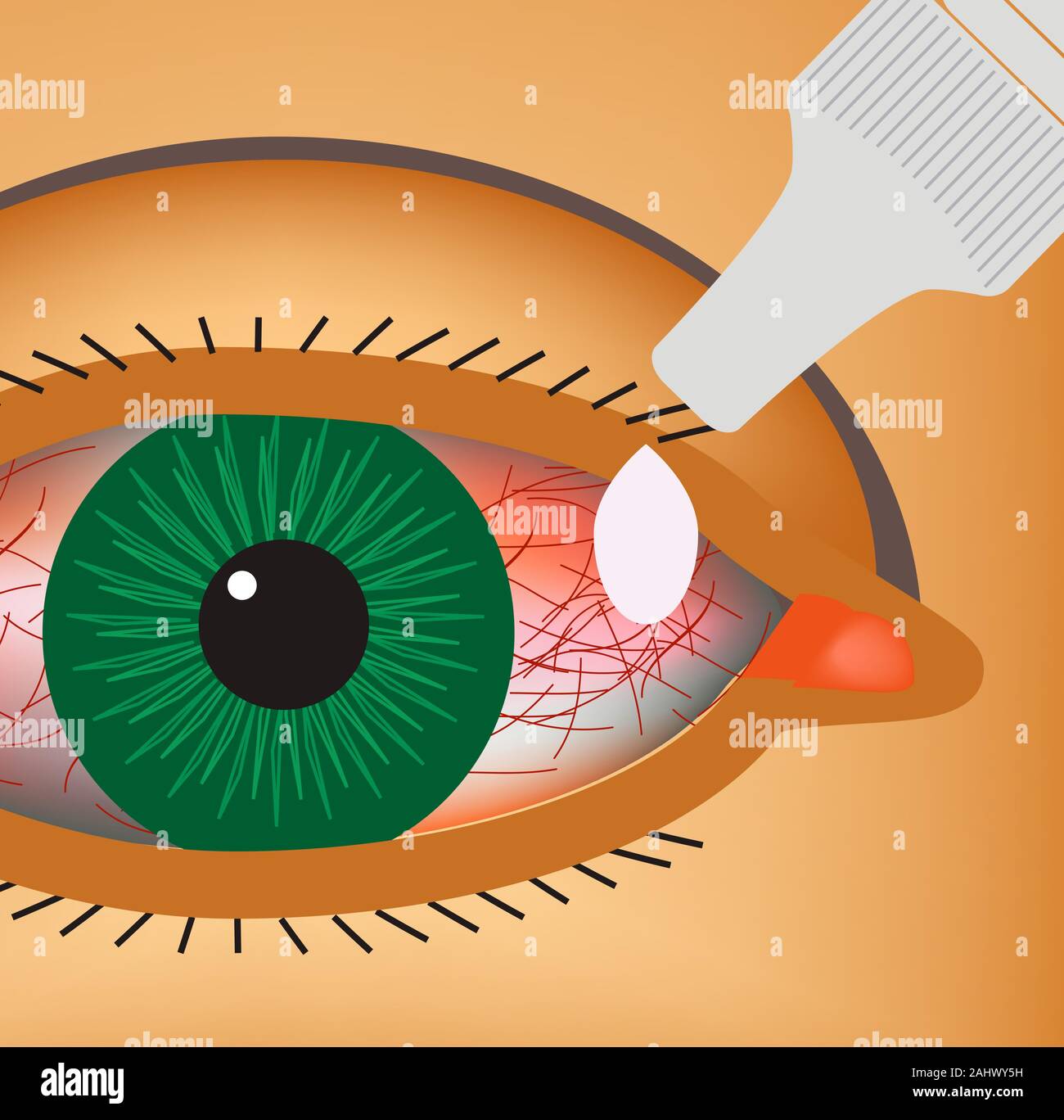 Inflammated eye Conjunctivitis or pink eye Stock Vector Image & Art