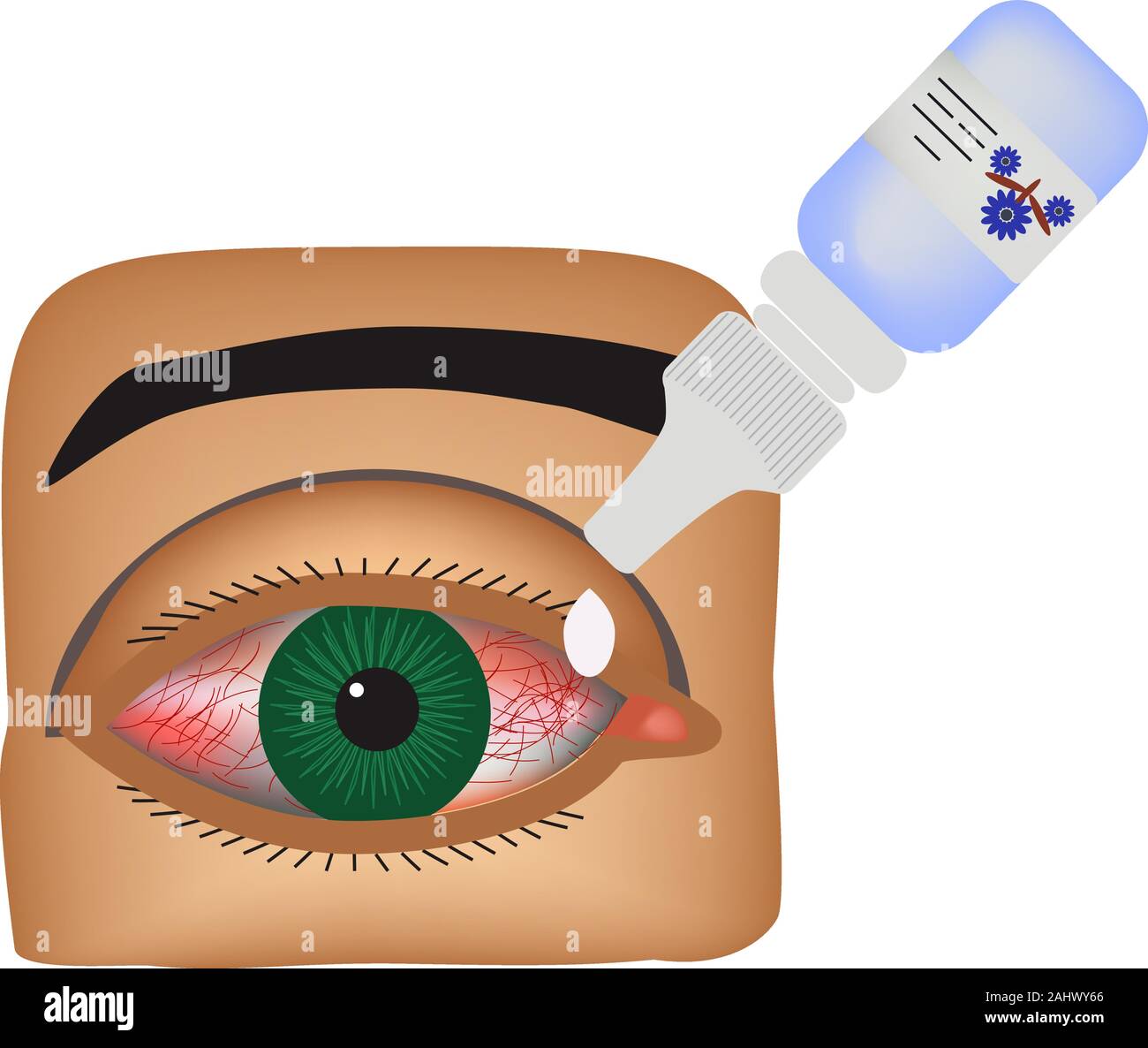 Conjunctivitis. Redness and inflammation of the eye. Vessels. Eye drops