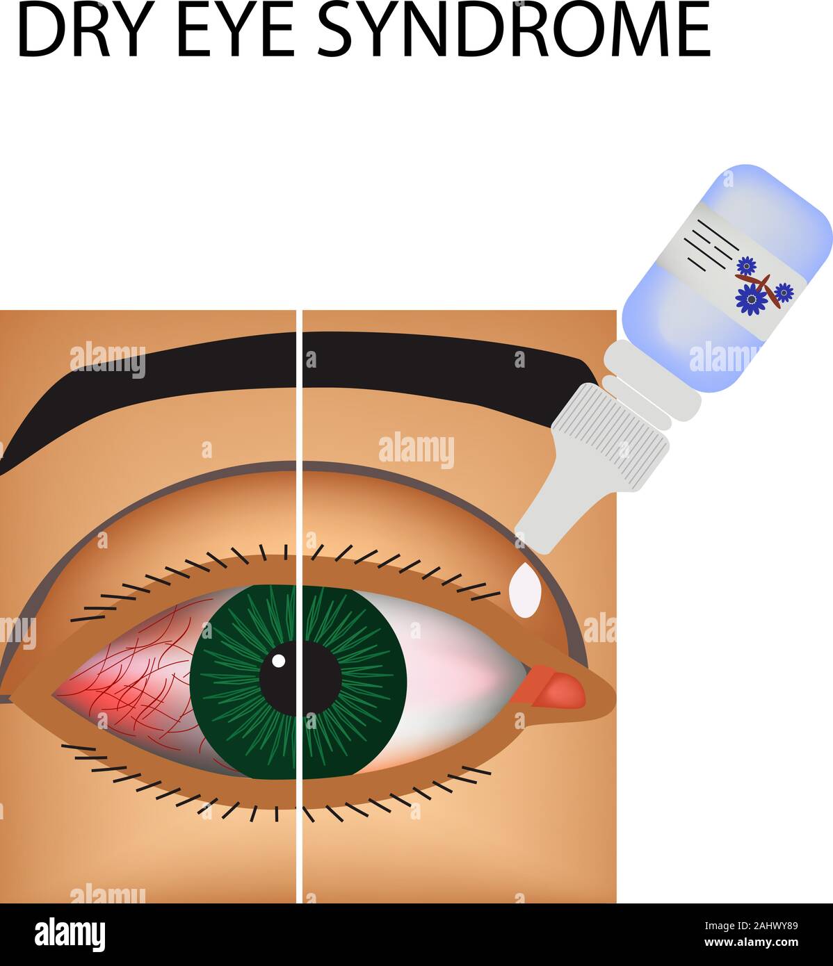 Conjunctivitis. Redness and inflammation of the eye. Vessels. Eye drops