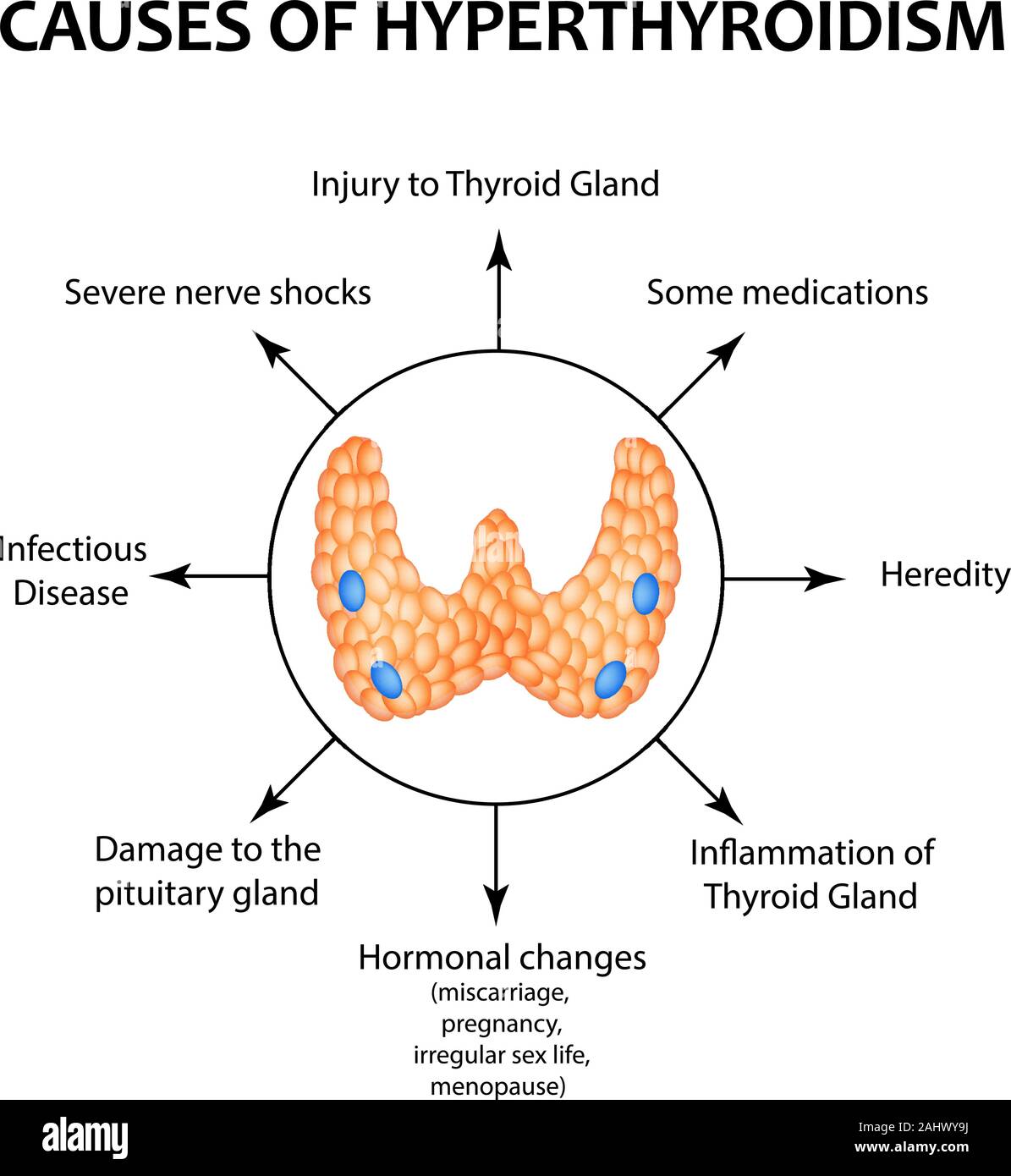 The causes of hyperthyroidism of the thyroid gland. Infographics. Vector illustration on isolated background. Stock Vector