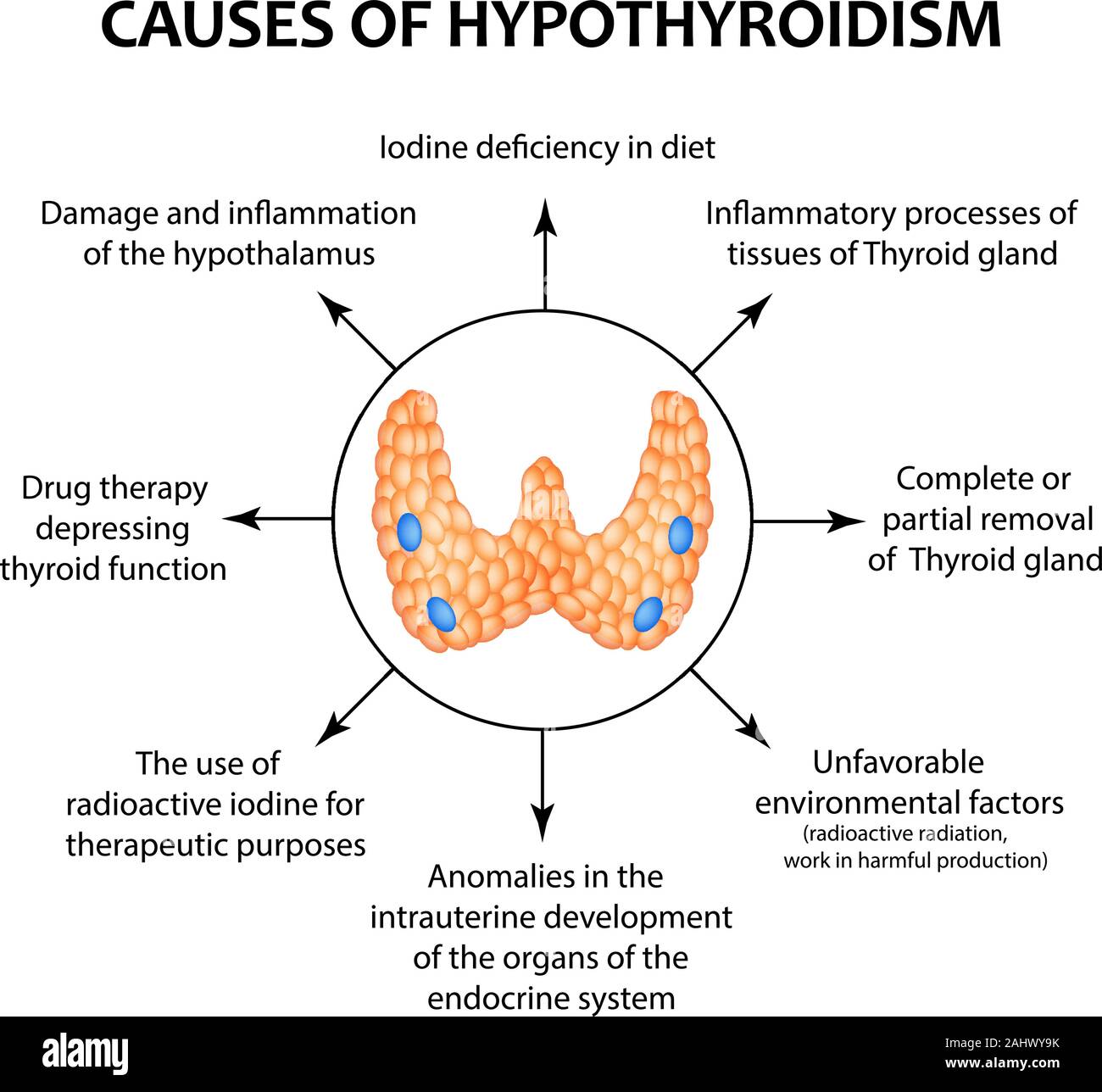 The causes of thyroid hypothyroidism. Infographics. Vector illustration on isolated background. Stock Vector