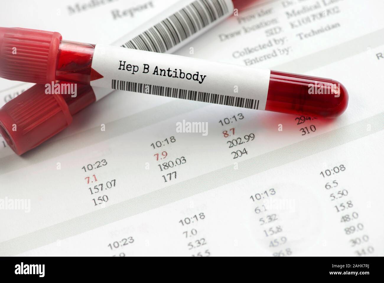 Hepatitis B antibody blood test on laboratory report. Hepatitis B ...
