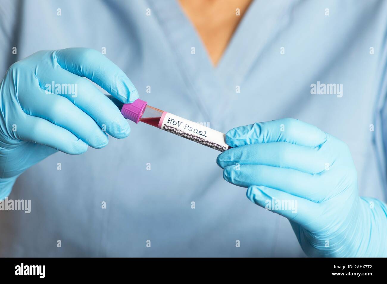 HBV-Hepatitis B Virus blood test tube.  The HBV test can help determine the the hepatits b infection status in patients  before beginning HCV treatmen Stock Photo