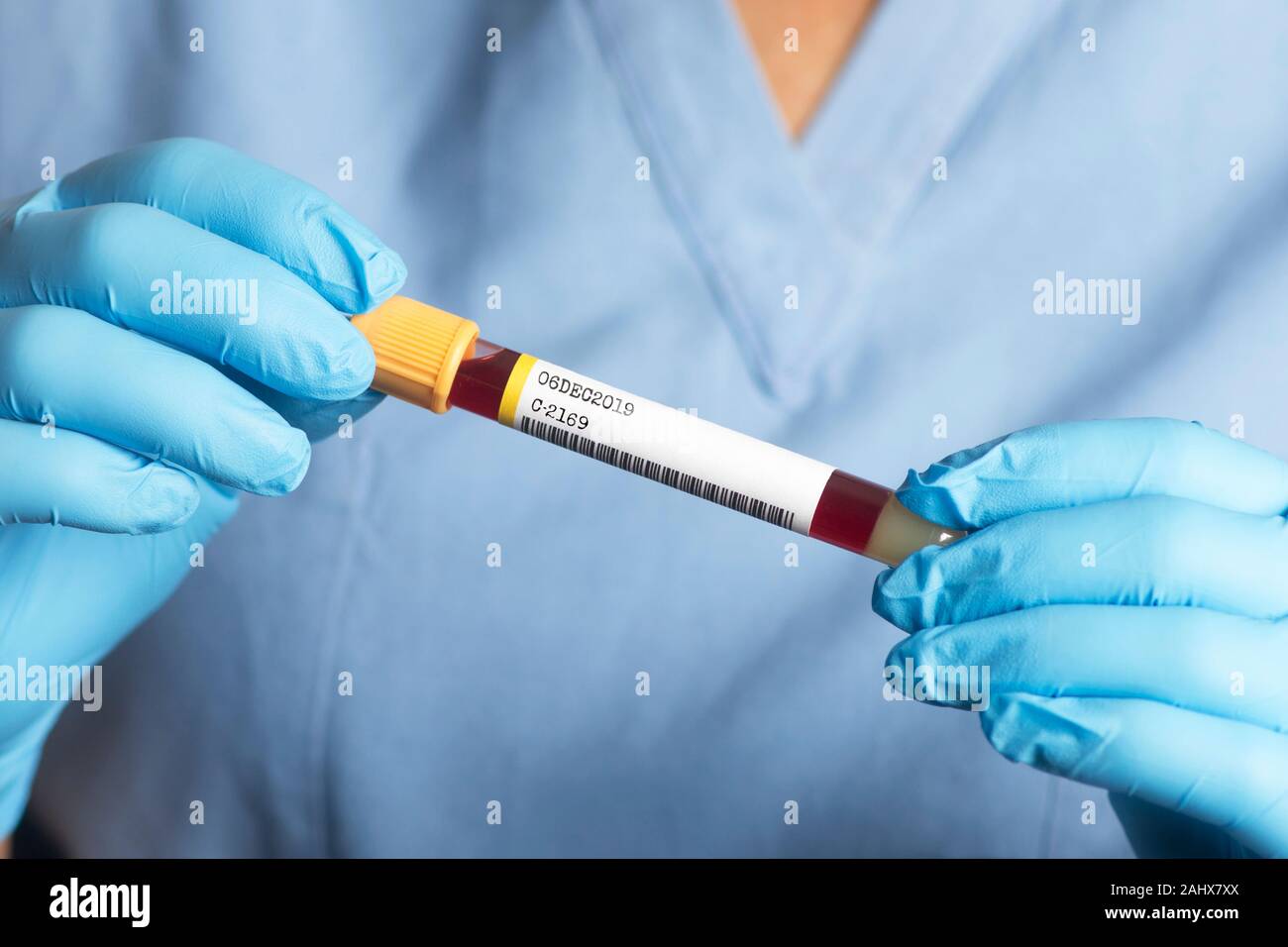 Laboratory technician holds blood sample tube with gold colored cap.  Gold test tubes are used for tests such as hepatic function panes. Stock Photo
