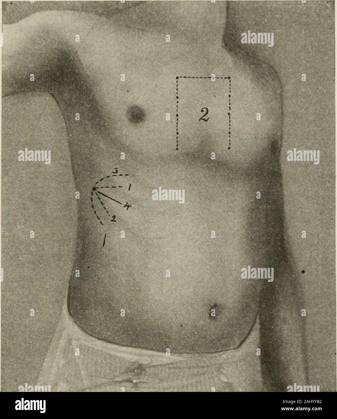 Infiltration anesthesia hires stock photography and images Alamy