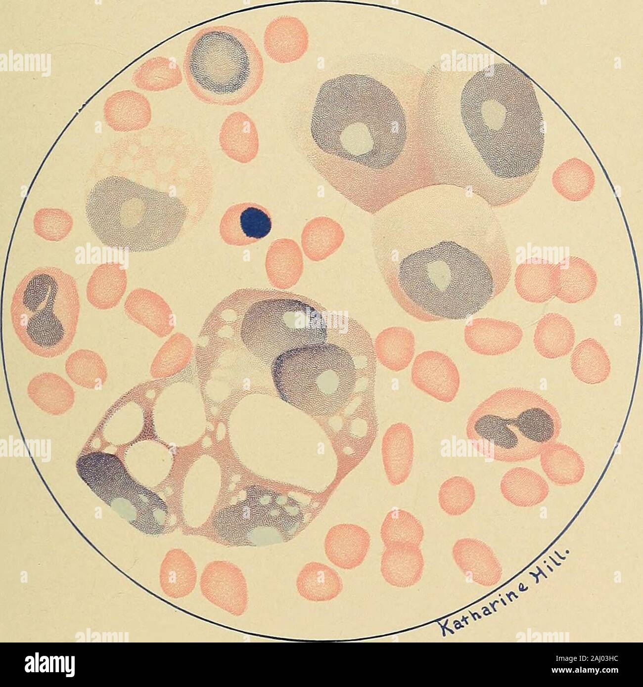 Diagnostic methods, chemical, bacteriological and microscopical : a text-book for students and practitioners . e complicatedthe condition than when it is due to a pure congestion. Numerous red cellsare especially observed in association with a congestive pleurisy. Peritoneal Exudates. The cytological examination of peritoneal exudates has, as yet, yieldedfewer diagnostic points than has that of pleural exudates. It is, however,sometimes possible to differentiate a tubercular peritonitis from an ascites oran ovarian cyst by means of such examinations. Tubercular peritonitisusually shows a lymph Stock Photo