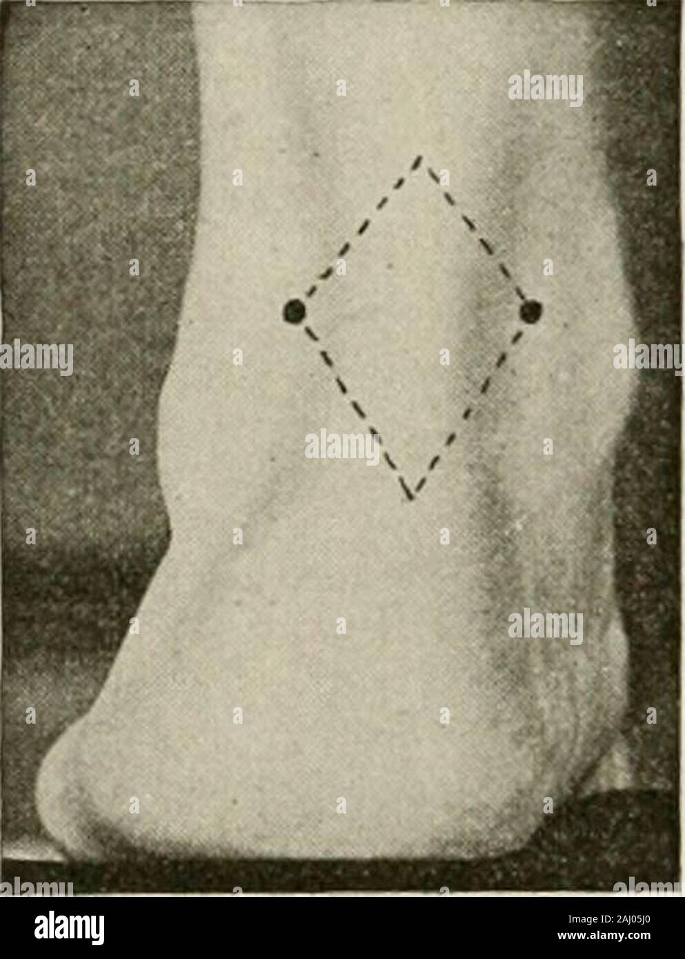 Local and regional anesthesia; with chapters on spinal, epidural, paravertebral, and parasacral analgesia, and other applications of local and regional anesthesia to the surgery of the eye, ear, nose and throat, and to dental practice . ous nerve; the extent of the resultinganesthesia is shown in Fig. 55, No. II. 278 LOCAL ANESTHESIA The injection in Experiment 2 reaches the terminal branchesof the internal saphenous nerve, and may often be combined with theinjection of the posterior tibial, as in Experiment i, for anesthesia ofthe inner side and sole of the foot. In commenting upon these expe Stock Photo