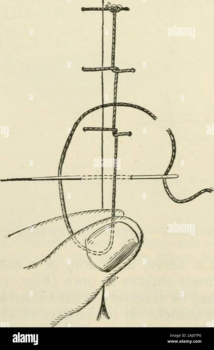 Modern surgery, general and operative . 116.—Continuous suture. geons knot or a reef knot. If a wound is on the face, particular care mustbe employed in closing it, in order to hmit the amount of disfigurement. Finesutures of silk or horsehair are passed with a small sharp needle or a subcuticularstitch is used. In a clean wound stitches may, as a rule, be removed in from. Stock Photo