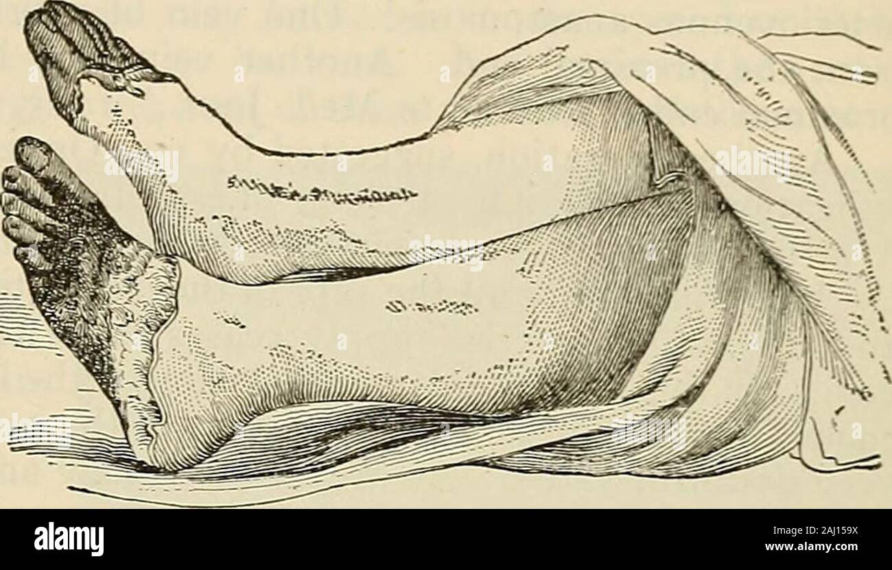 Modern surgery, general and operative . umber of months erythromelalgia may develop. Inthis condition when the foot is hung dowoi the toes and dorsum of foot ratherrapidly grow bright red. After a case has lasted for many months it will be impossible at any timeto detect a pulse in the dorsahs pedis or posterior tibial. The patient is wear-ing out with violent pain and cannot walk. Whenever the foot hangs down itbecomes red or cyanotic. A bleb or ulcer may form upon the foot or great toe;it is sure to be intensely painful, and finally dry gangrene occurs. Gangrenemay occur in a few months afte Stock Photo