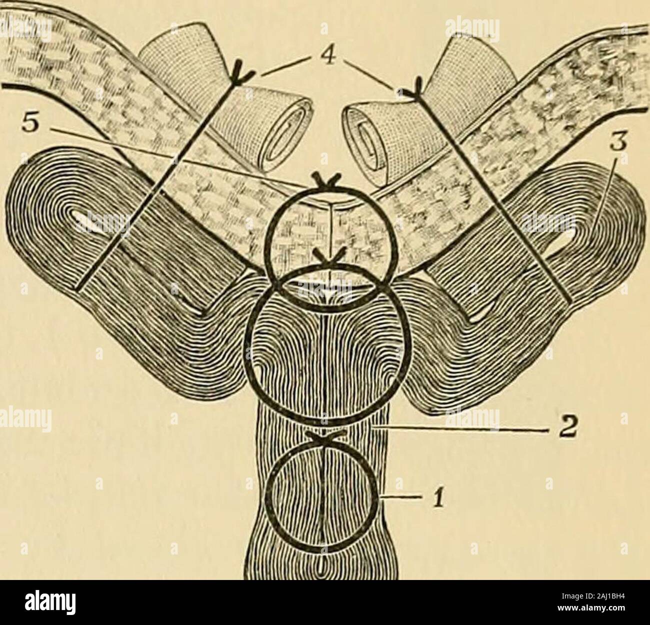 Operative surgery . Fig. 246.—The sacciform aneurism. Trans-verse section.  1. The line of suturesclosing the orifice over catheter—newlumen (Fig.  244); 2. The second rowof sutures reducing size of sac (Figs.237 and 238);