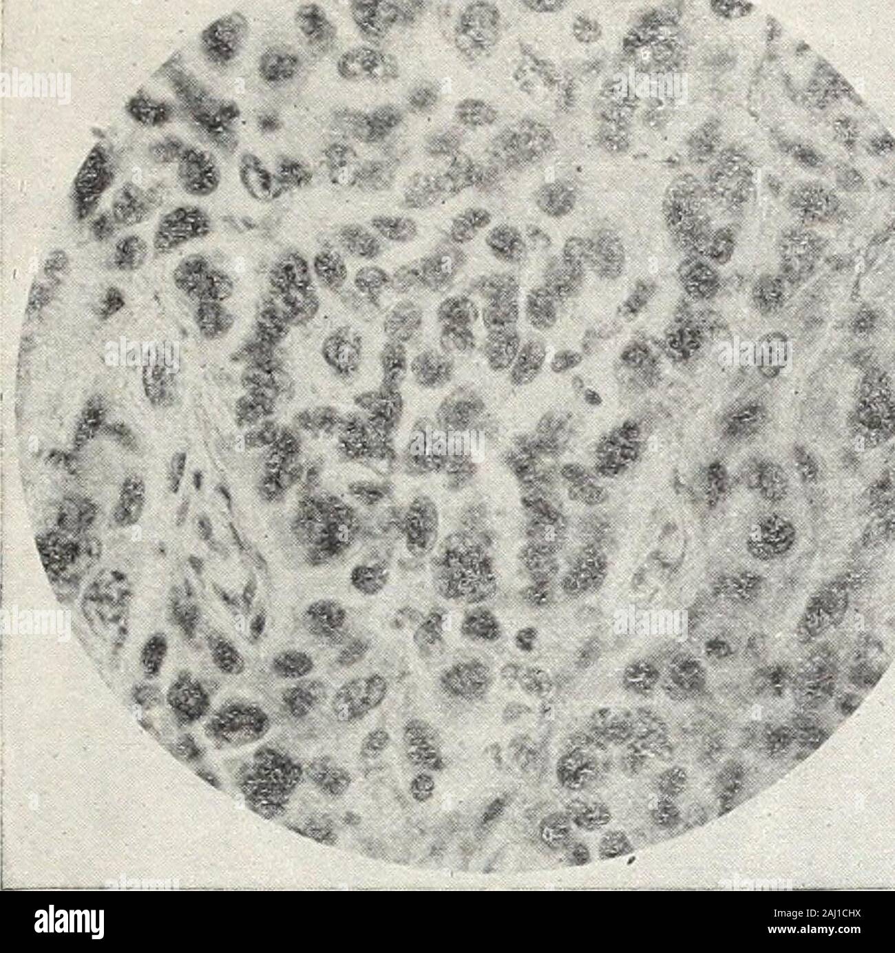 Mt Sinai Hospital Reports . Fibro carcinoma (scirrhus) with primary tumor in the prostate. X 250.. J Fig. 9. Fibro-carcinoma (scirrhus) of medullary type. X 250. Stock Photo