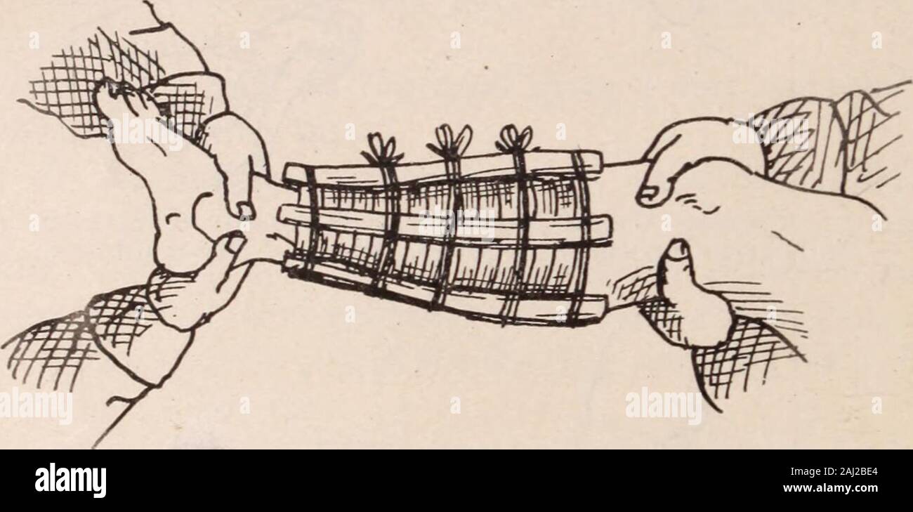 Interstate medical journal . Fig. 4. Applying the waxed compresses