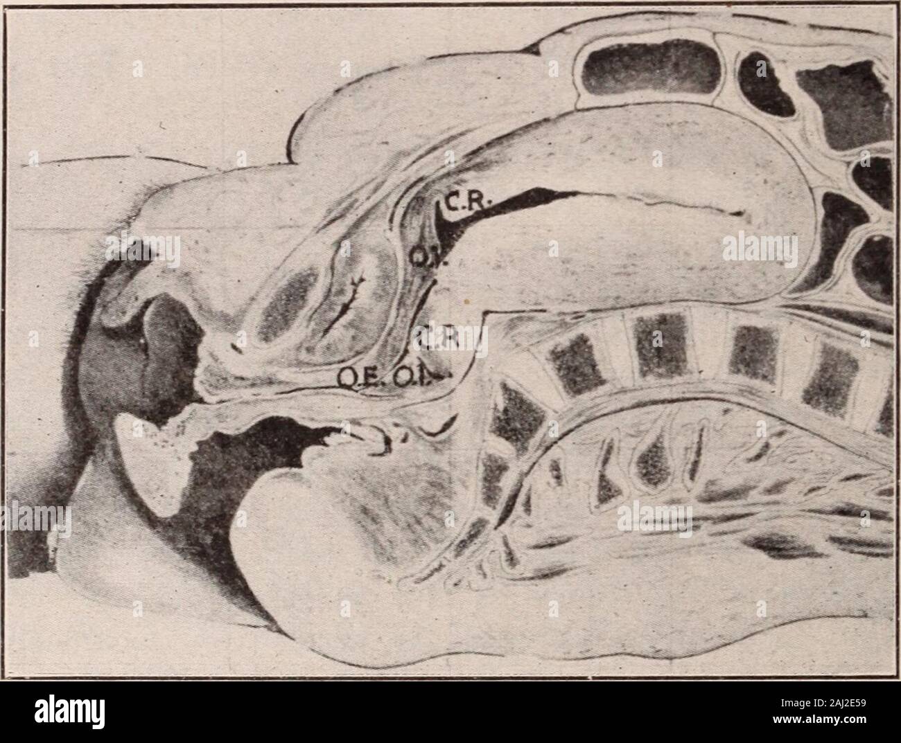 Traction Rd Fundus Interstate medical journal . r area is stretched by the traction of the ...