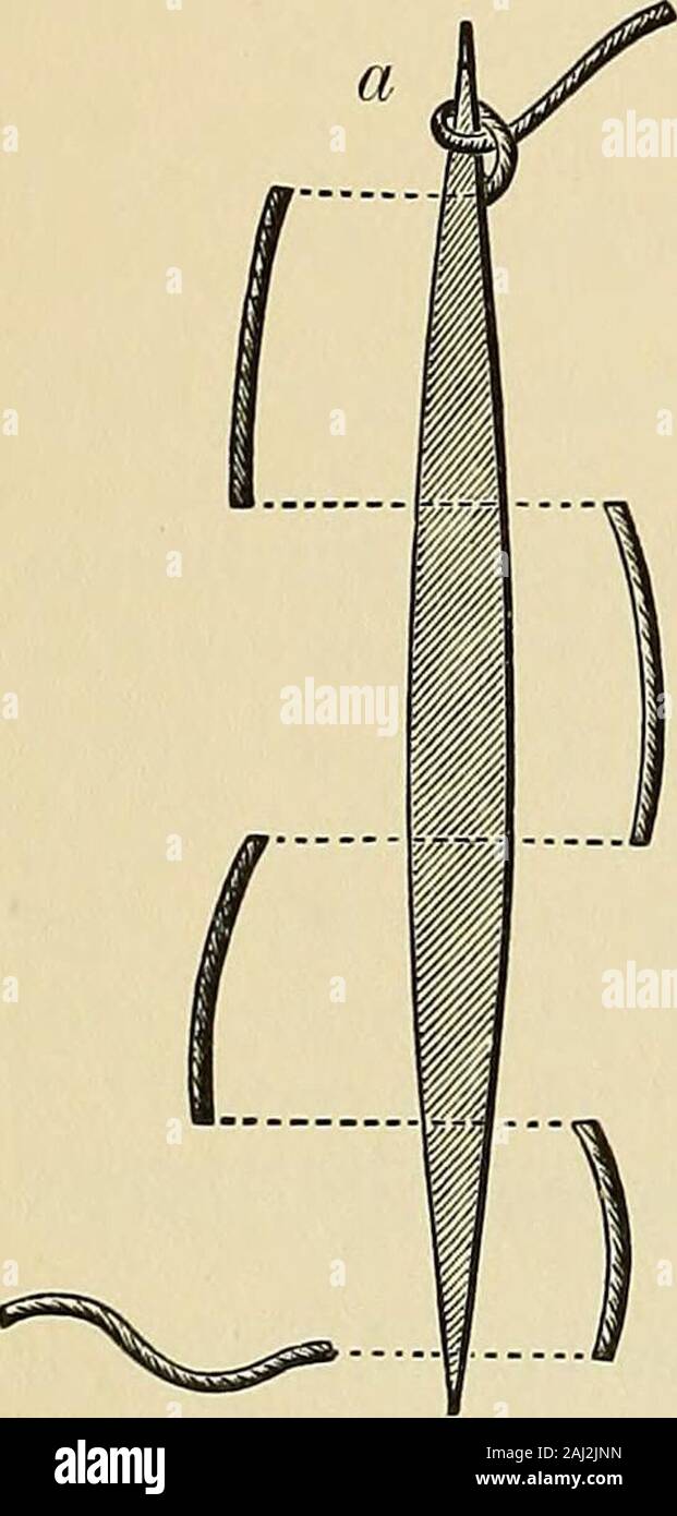 Operative surgery . posite side andtied (Fig. 1331, Vol. II). Fine catgut, silk, or wire are used in this instance. The Relaxation and Coaptation Su-ture (Figs. 149, 150).—As the nameindicates, this suture is a double oneand meets dual indications. It not onlyapproximates the deep tissues in itsgrasp (mattress stitch, a), and relaxesthe superficial (relaxation suture), butis employed also to unite the relaxedborders (continuous stitch, h) of thewound (coaptation suture). The three-cornered wound suturesand their uses are explained at onceby the illustrations of their application(Figs. 151,153) Stock Photo