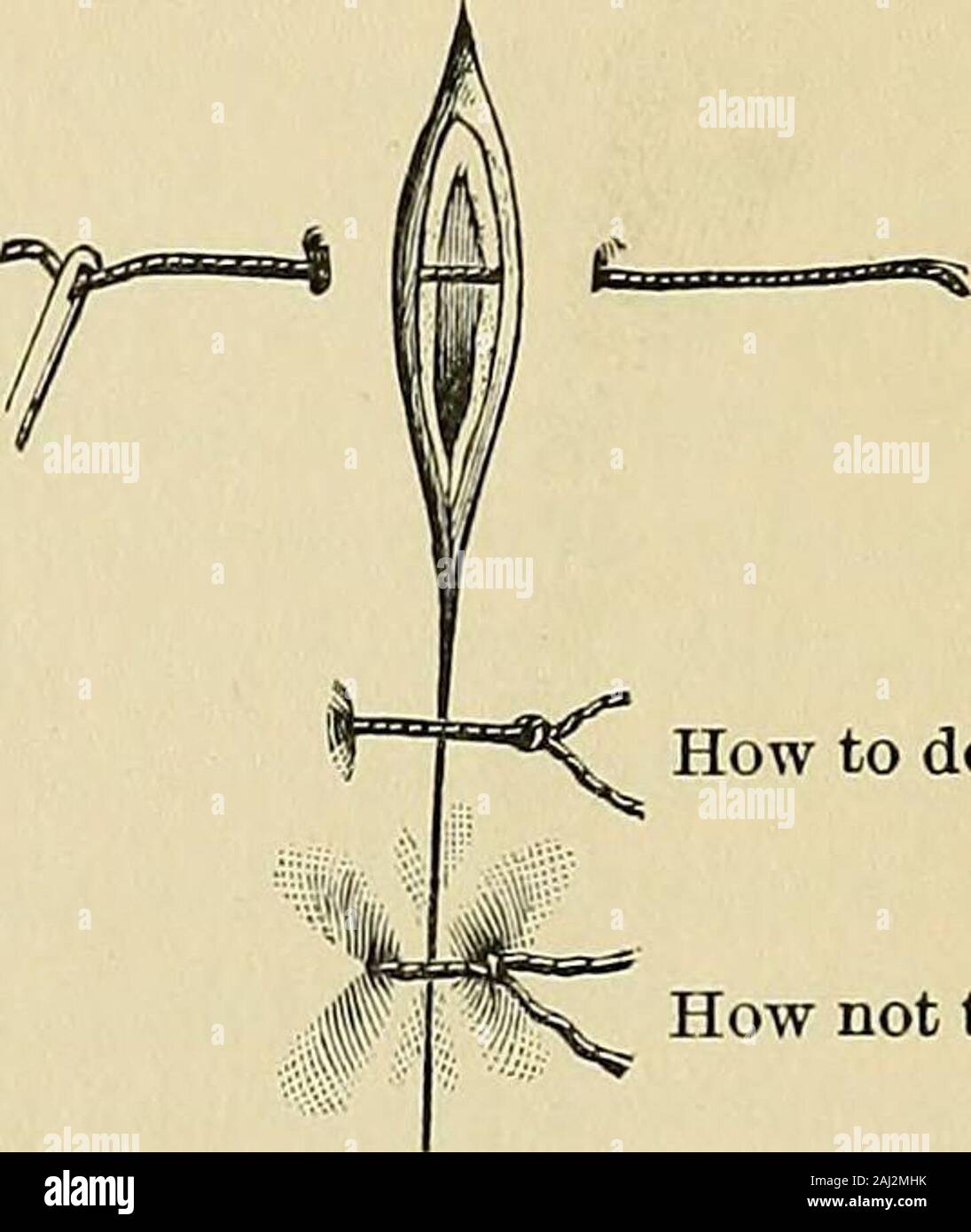 Operative surgery . How to do it. How not to do it. Fig. 137.—Tension while  sewing. Fig. 138.Tension of sutures. main in situ is governed by the  liability to ulceration and disfigurement