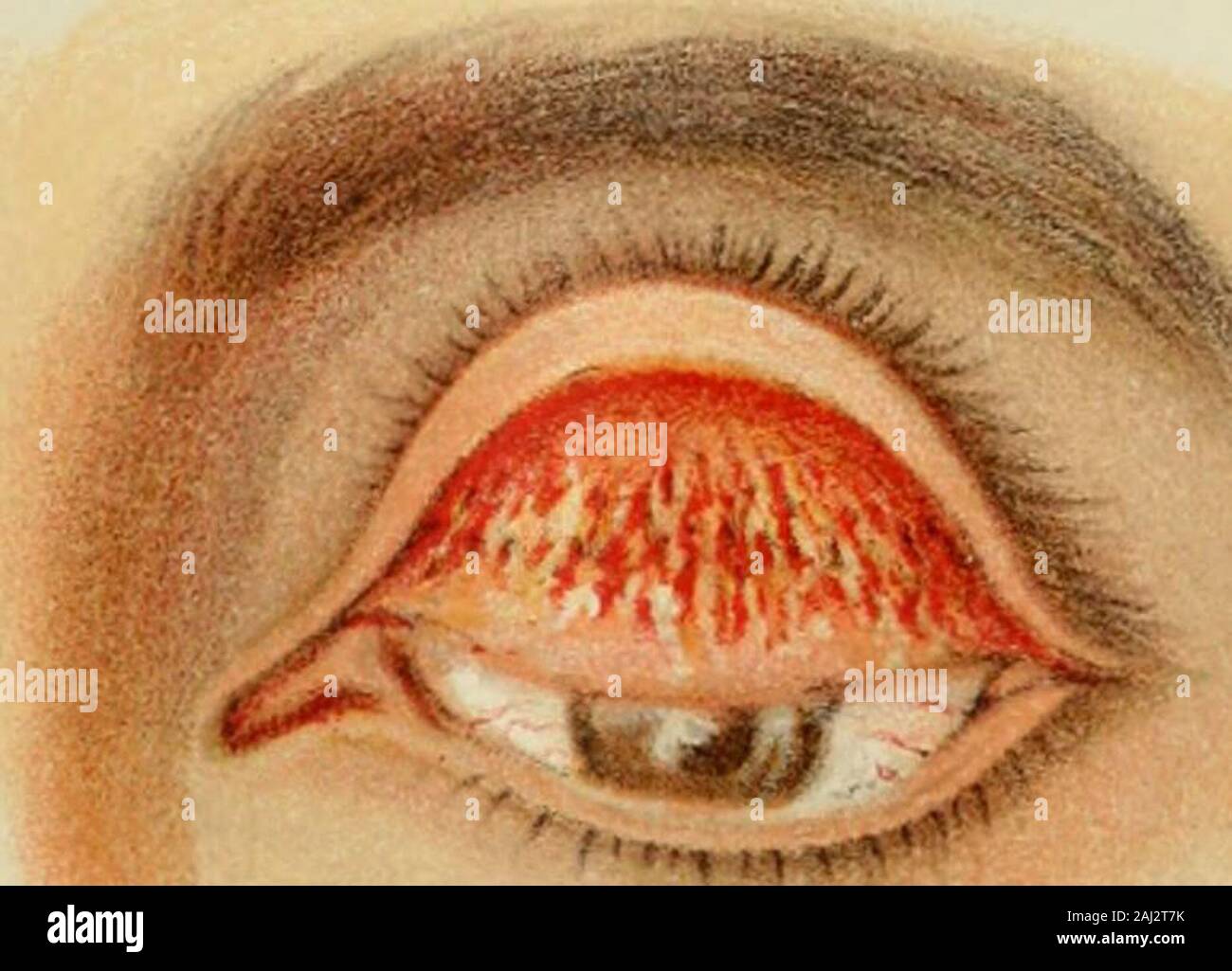 Public health bulletin . Fig. 3-Trachoma-Cicatrization well marked.. Fig. 4-Trachoma-Showing connection tissue formation. L.h. Wilder, del. BREOHE1 S • Stock Photo