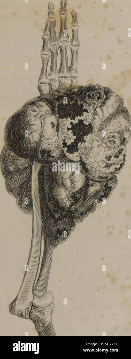 The institutes and practice of surgery: being the outlines of a course of lectures . tomatous mat-ter. (See Plate I.) Treatment of Spina Ventosa. When the smaller bones, such as the phalanges of thefingers and toes, are affected with spina ventosa, a curemay sometimes be produced by moderate long continuedpressure directly over the tumour; at other times, I havesucceeded by making an opening into its cavity, and bystimulating injections, or by cutting instruments, excitingsuch a degree of irritation, as to cause it to fill up withgranulations. In this way I once cured an obstinate spinaventosa Stock Photo