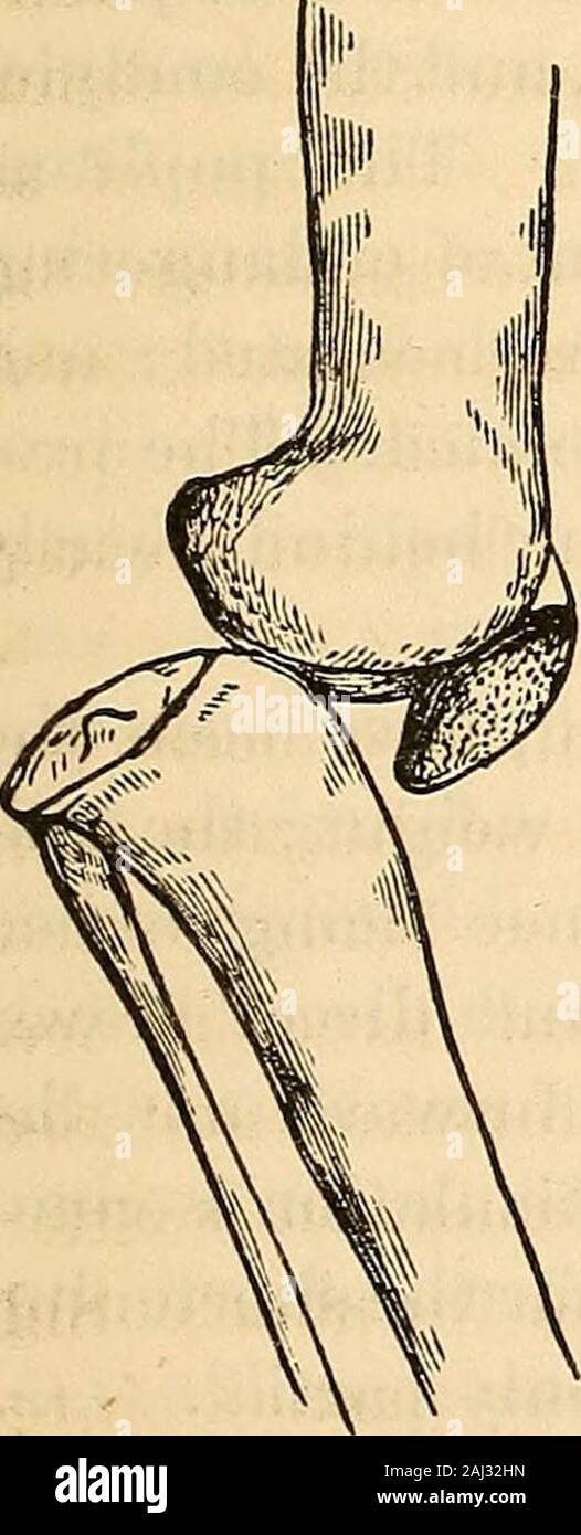 Tibia Dislocation Anterior knee dislocation tibia femur hi-res stock photography and ...