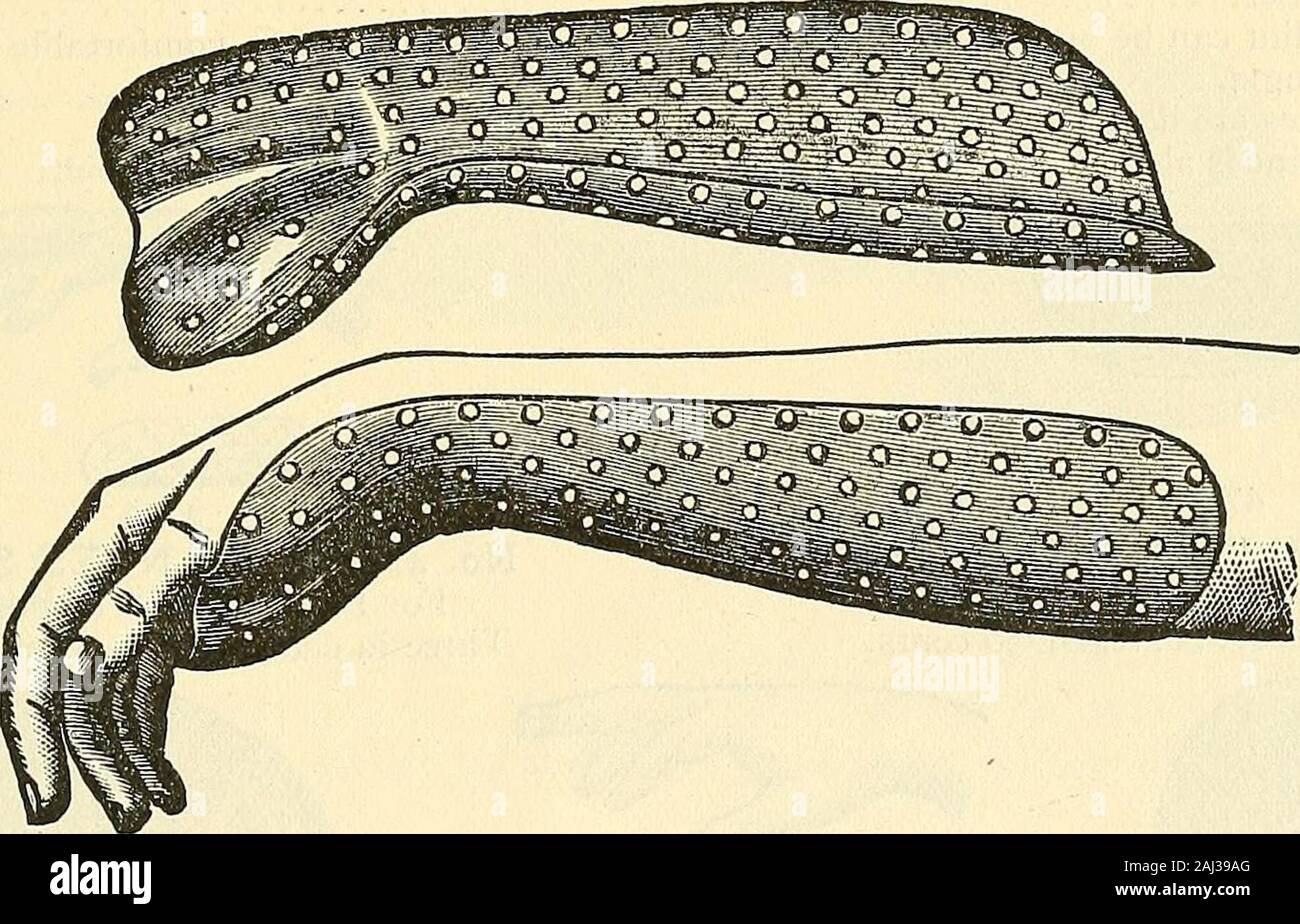 Catalogue of Sharp & Smith : importers, manufacturers, wholesale and retail dealers in surgical instruments, deformity apparatus, artificial limbs, artificial eyes, elastic stockings, trusses, crutches, supporters, galvanic and faradic batteries, etc., surgeons' appliances of every description . accurately that but little padding is required; a piece of woven lint or ofcotton or woolen flannel, is all that is necessary for their lining. A slight roughness is left onthe outside of the Splints by perforations to prevent the bandage from slipping. They arenickel-plated to prevent oxidation. They Stock Photo